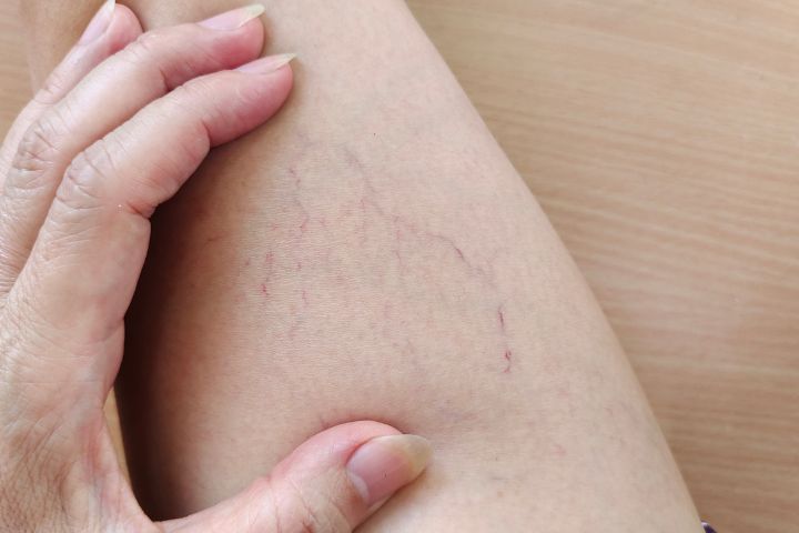 What's Behind the Sudden Appearance of Pesky Spider Veins?