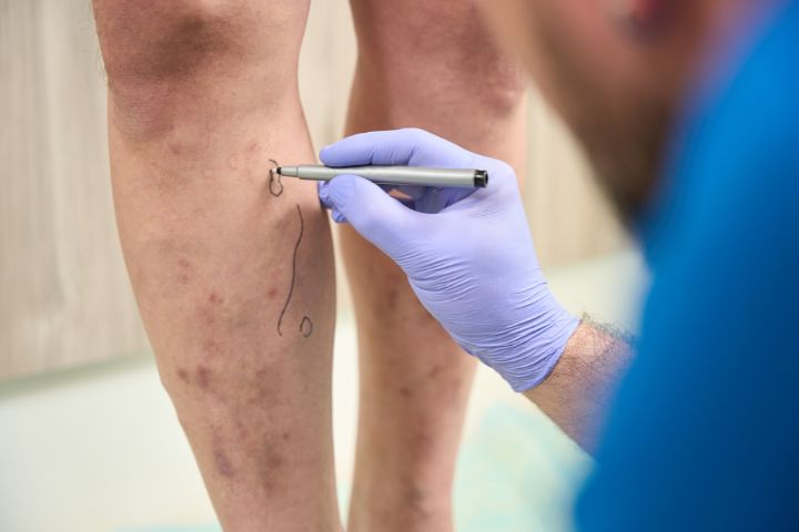 Sclerotherapy An Effective Treatment for Varicose and Spider Veins