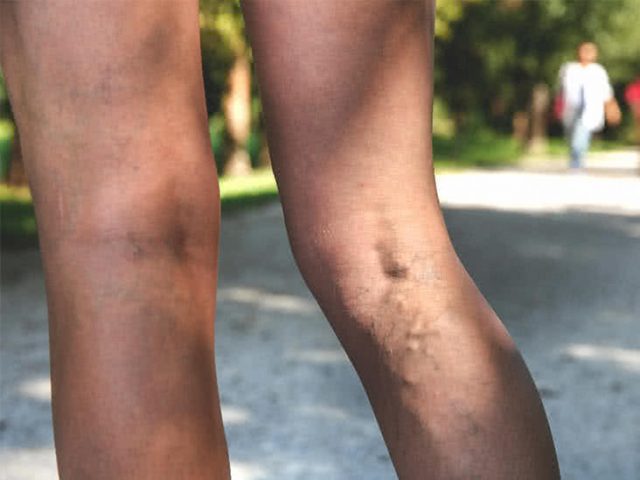 Some Treatment Options for  Saphenous Veins