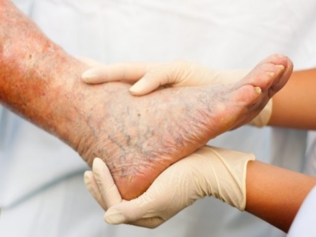Can vein disease be prevented?