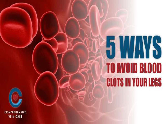 5 Ways To Avoid Blood Clots In Your Legs