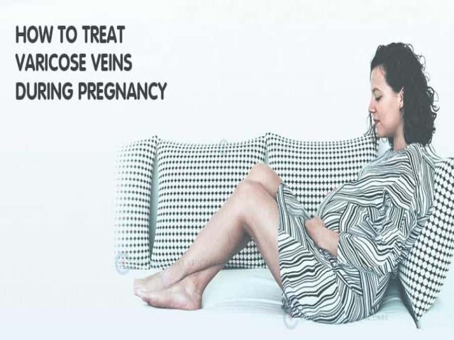 How to Treat Varicose Veins During Pregnancy